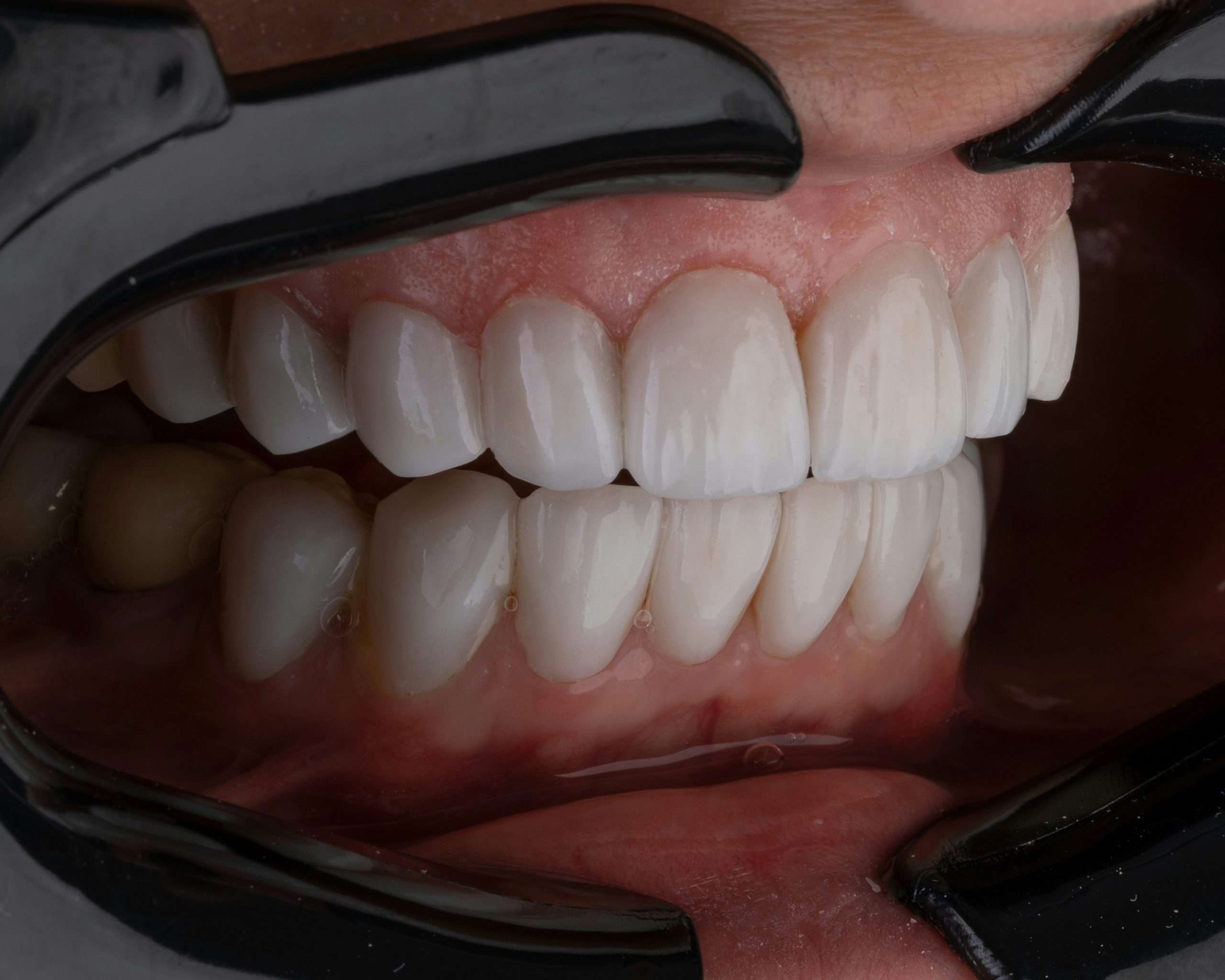 Essential Guide to Wisdom Tooth Removal