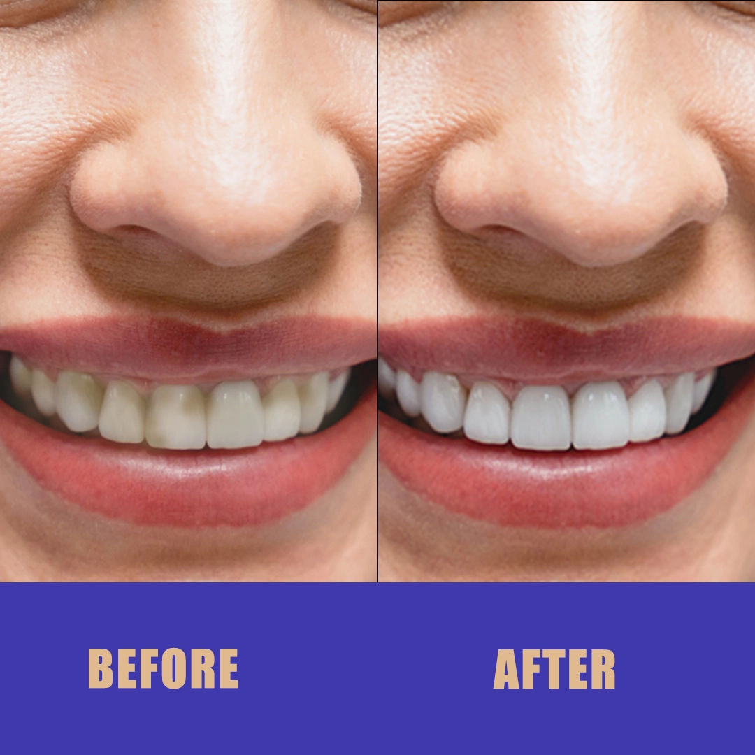 Veneers Journey: Stunning Before and After Results